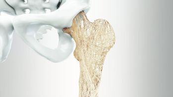 osteoporosis